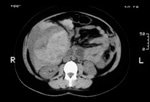A CT scan showing a large bleed into the right hemi-liver 