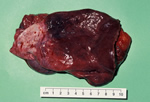 Right liver specimen